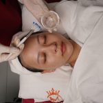 Skin Laser Peel tại Skin Plus Dermatology