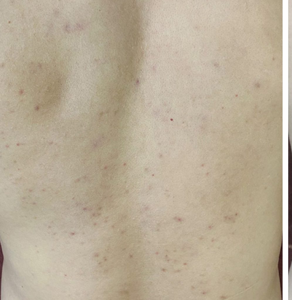 Giảm mụn lưng & thâm sau mụn – Trước