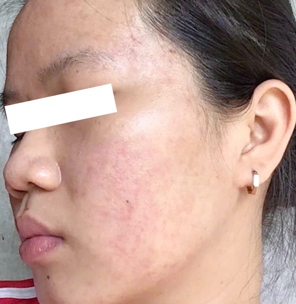 Giảm mụn viêm rõ rệt – Sau