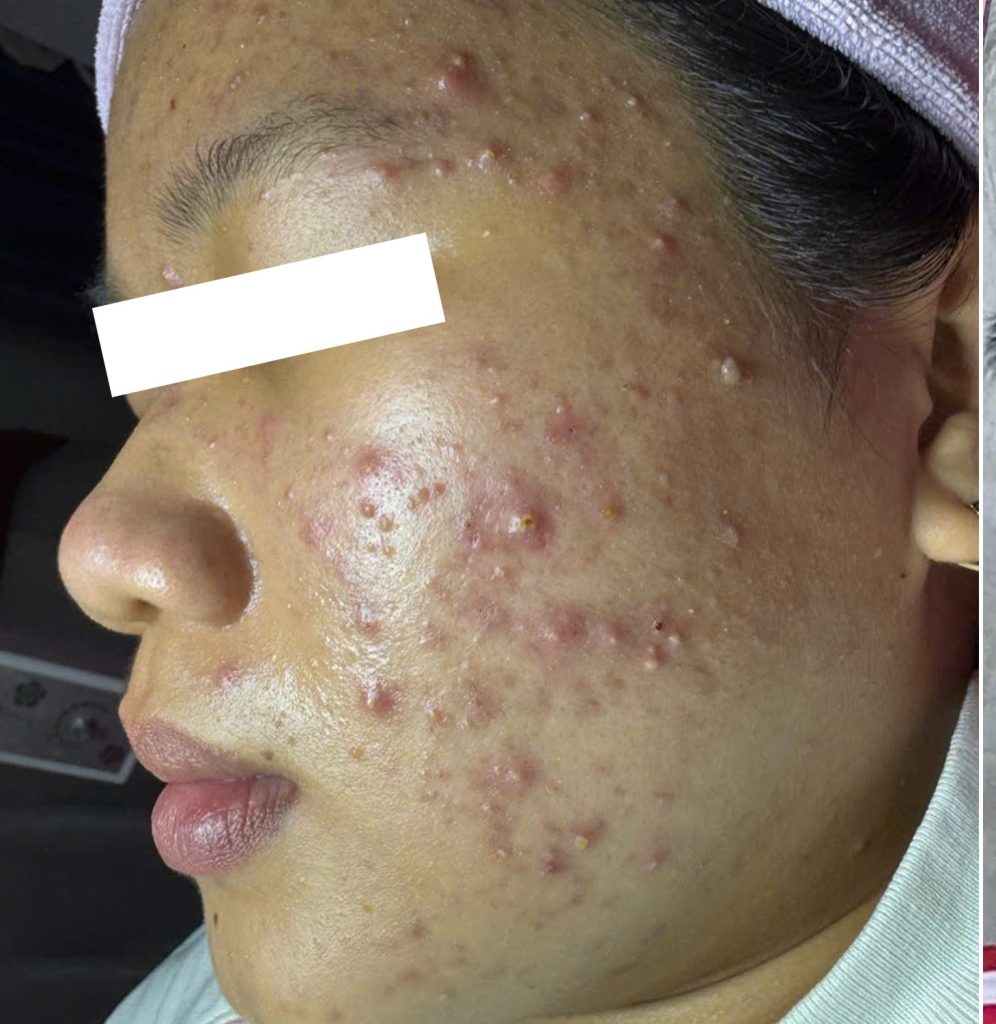 Giảm mụn viêm rõ rệt – Trước