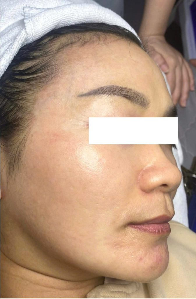 Điều trị nám lâu năm – Sau