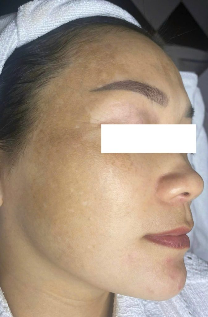 Điều trị nám lâu năm – Trước