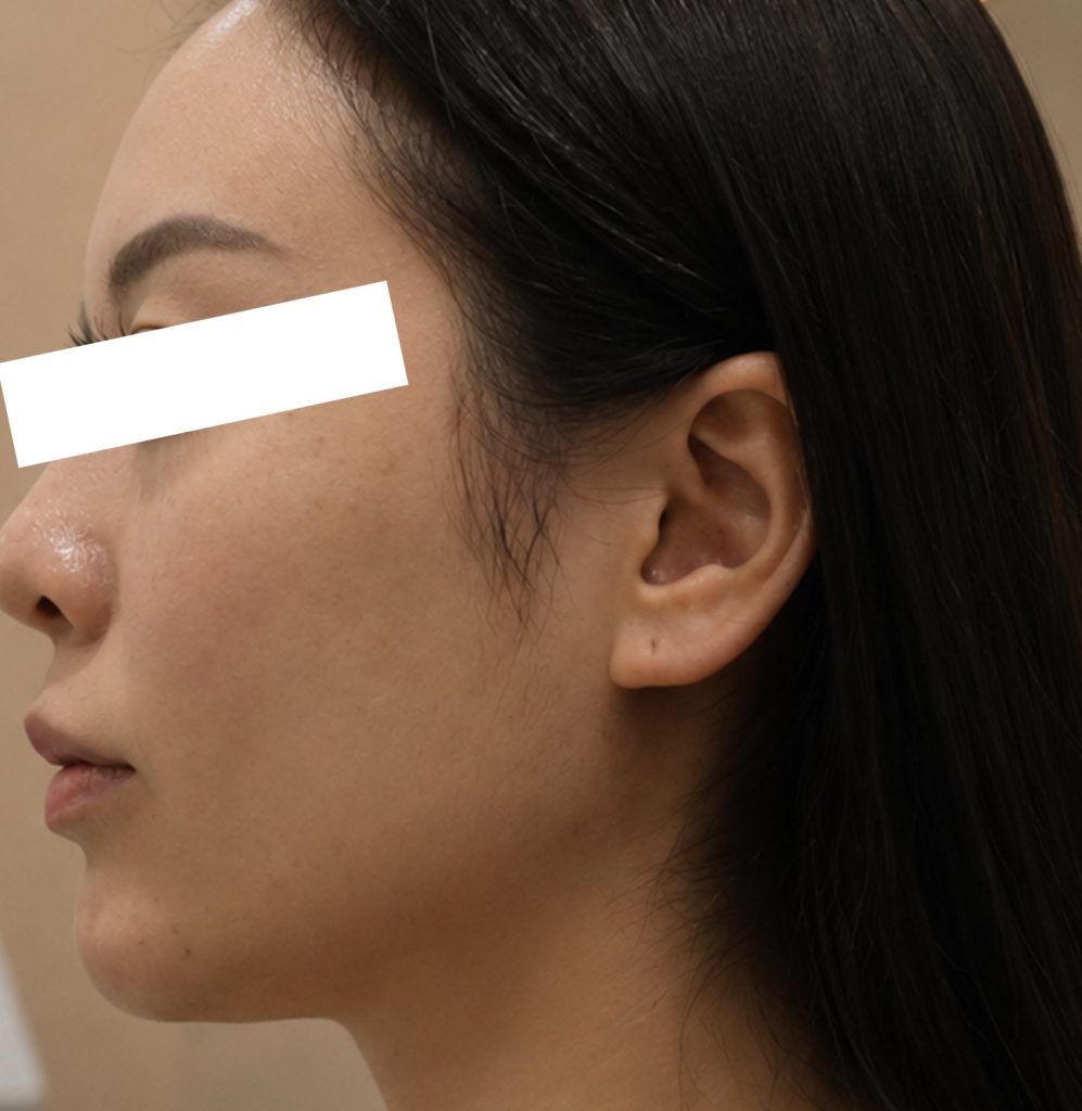 Nâng cơ – trẻ hóa da – Sau